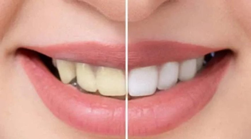 പല്ലിലെ കറ കളയാം ഈസിയായി..